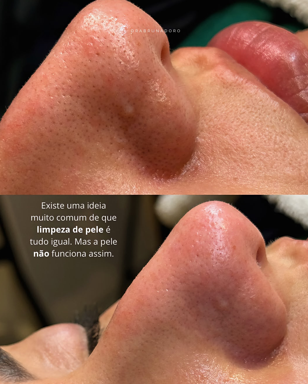 Sua pele anda opaca, com cravos ou acne? Talvez o que esteja faltando é uma limpeza de pele profissional! Resultados reais começam na base: limpeza + preparo + tratamento. Agende a sua e sinta a diferença!